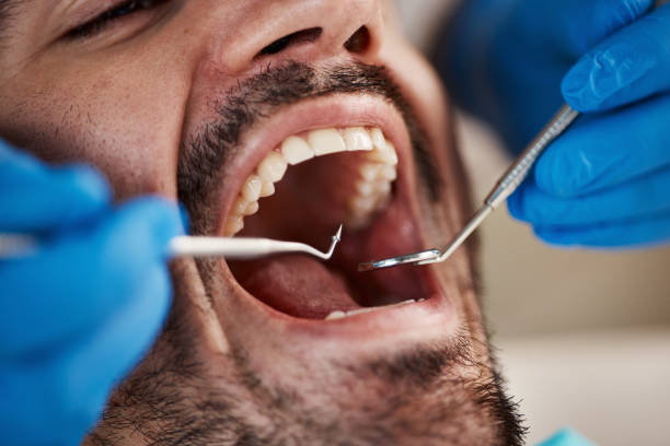 Best Emergency Dental Care for Broken or Chipped Teeth in Davie, FL
